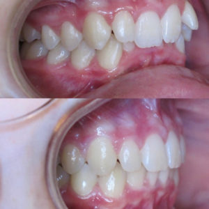 Bandeen Orthodontics Case Study #25