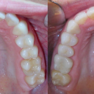Bandeen Orthodontics Case Study # 26