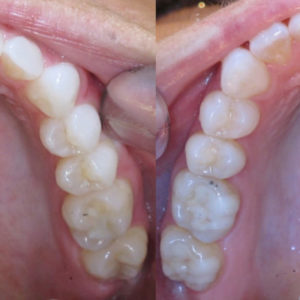 Bandeen Orthodontics Case Study #27