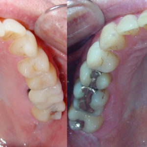Bandeen Orthodontics Case Study #30
