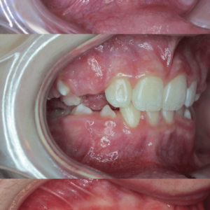 Bandeen Orthodontics Case Study #46