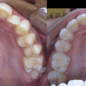 Bandeen Orthodontics Case Study #13
