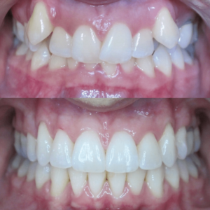 Bandeen Orthodontics Case Study #14