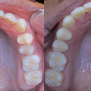 Bandeen Orthodontics Case Study #18