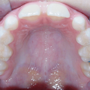 Bandeen Orthodontics Case Study #41