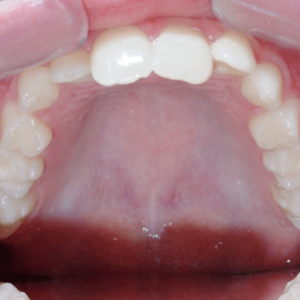 Bandeen Orthodontics Case Study #48