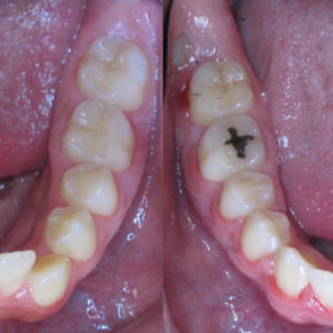 Bandeen Orthodontics Case Study #31