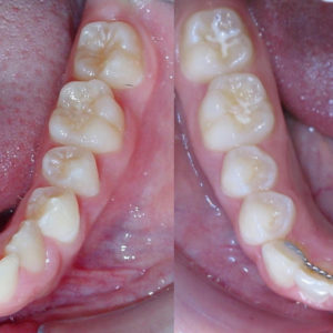 Bandeen Orthodontics Case Study #32