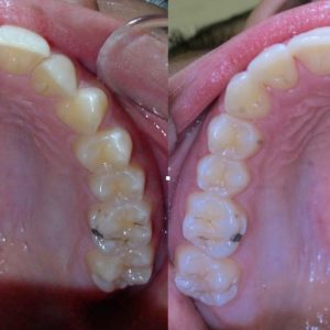 Bandeen Orthodontics Case Study #35