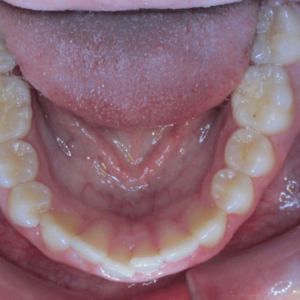 Bandeen Orthodontics Case Study #41