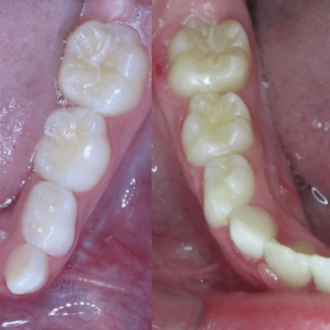 Bandeen Orthodontics Case Study #51