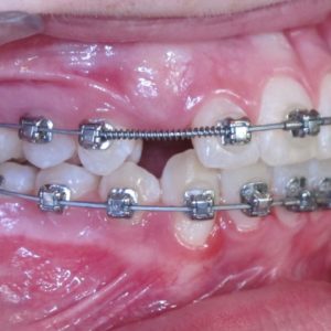 Bandeen Orthodontics Case Study #20