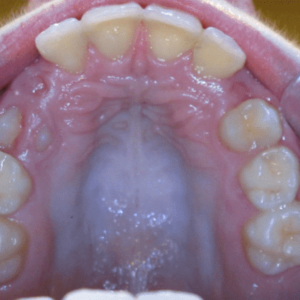 Bandeen Orthodontics Crowding Case 39