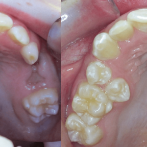Bandeen Orthodontics Case Study #43