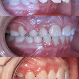 Bandeen Orthodontics Case Study #44
