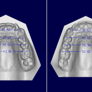 Bandeen Orthodontics Case Study #17