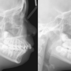 Bandeen Orthodontics Case Study #13