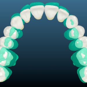 Bandeen Orthodontics Case Study #16