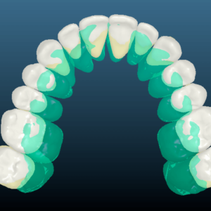 Bandeen Orthodontics Case Study #19