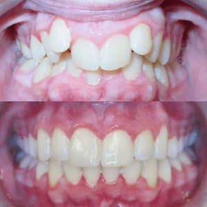 Bandeen Orthodontics Full Treatment Class II Case Studies