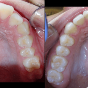 Bandeen Orthodontics Class II Case Studies