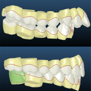 Bandeen Orthodontics Class II Case Studies