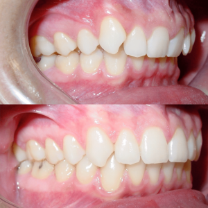 Bandeen Orthodontics Class II Orthodontics Case Studies