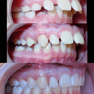 Bandeen Orthodontics Full Treatment Class II Case Study