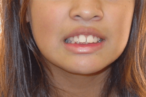 Case Study 2 – Orthodontic Class II