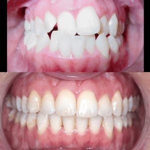 Bandeen Orthodontics Class III Full Treatment Case Studies
