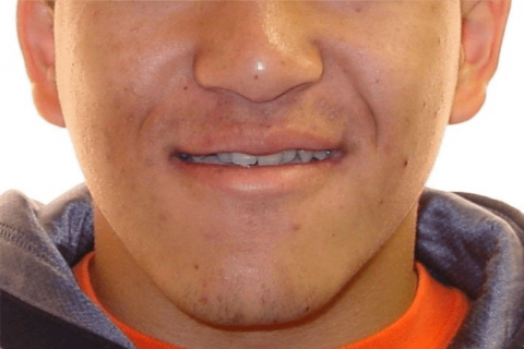 Case Study 11 – Orthodontic Class III