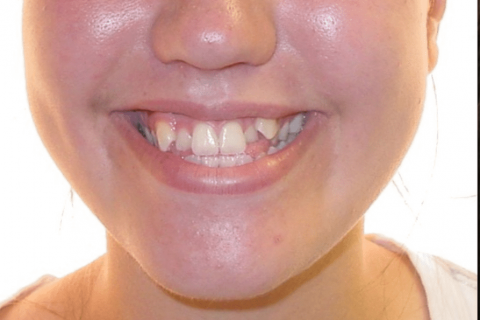 Case Study 8 – Orthodontic Class III