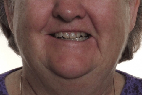 Case Study 10 – Orthodontic Class III