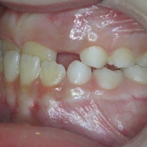 Bandeen Orthodontics Case Studies Early Treatment Crossbite
