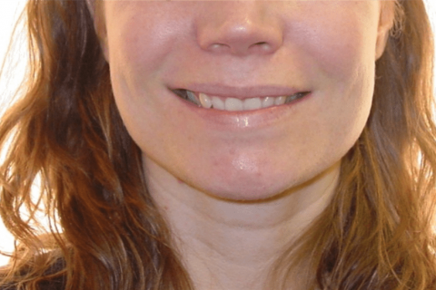 Case Study 1 – Orthodontic Class II