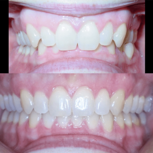 Bandeen Orthodontics Case Studies Ortho Class II