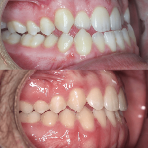 Bandeen Orthodontics Class III Full Treatment Case Studies