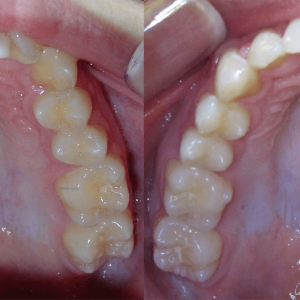 Bandeen Orthodontics Full Treatment Class II Case Studies