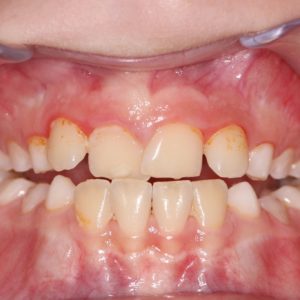 Bandeen Orthodontics Case Study #45