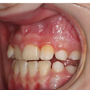Bandeen Orthodontics Case Study #45