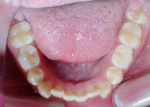 Bandeen Orthodontics Early Treatment
